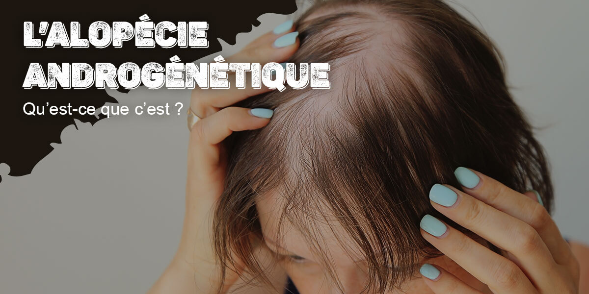 L’alopécie androgénétique, c’est quoi ?